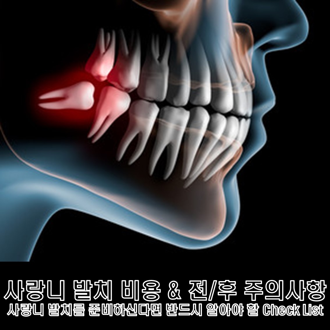 매복 사랑니 발치 비용 & 발치 전후 주의사항 사랑니 발치를 준비하신다면 필수 Check!